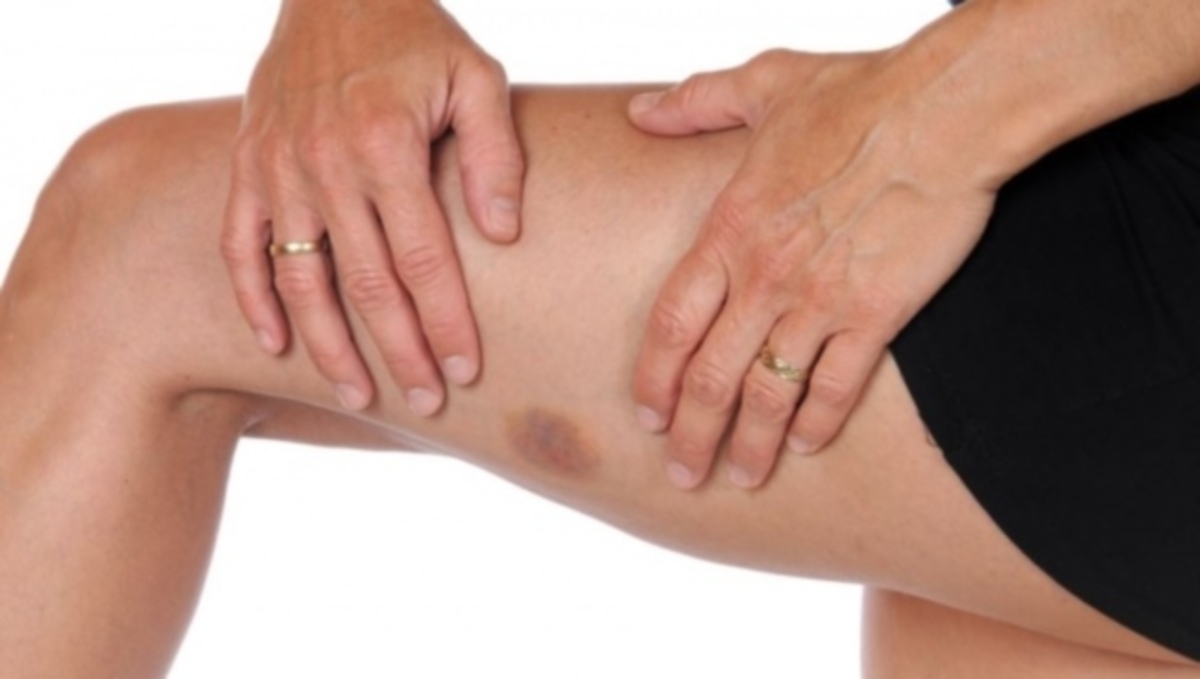 Γιατί έχετε ξαφνικές μελανιές στο δέρμα σας – Πώς να τις προλάβετε