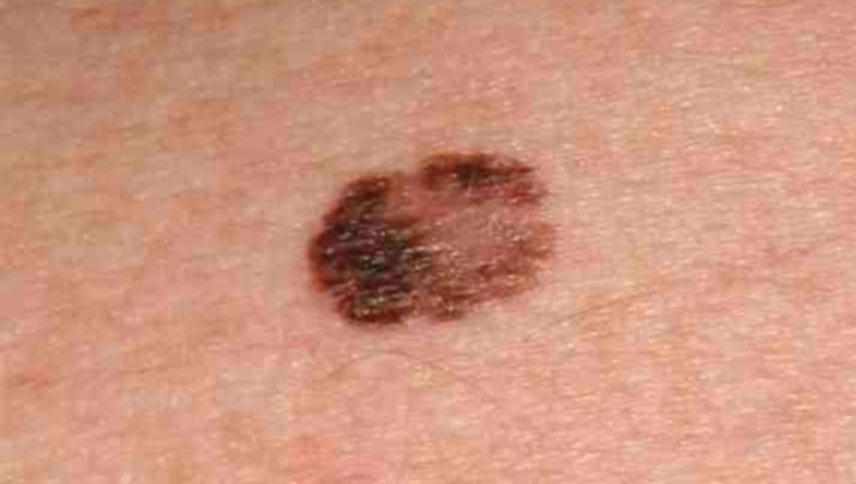 Προσοχή: Πότε οι ελιές γίνονται καρκινικά μελανώματα