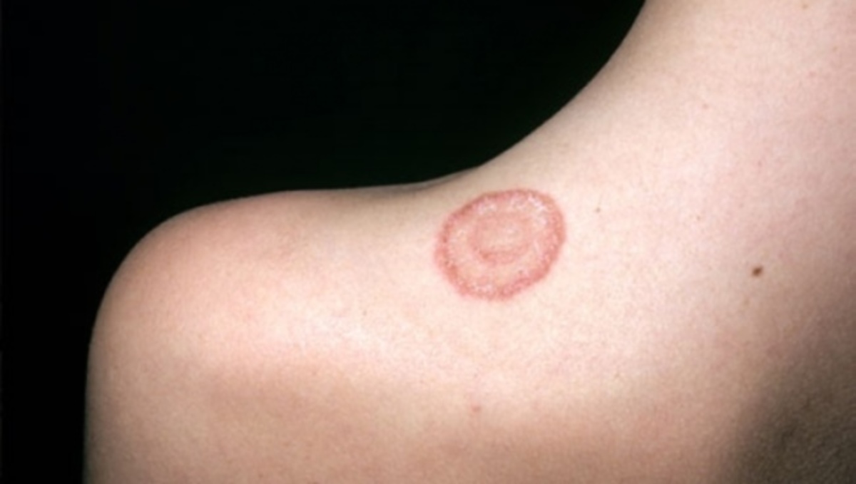 Προσοχή: Τι σημαίνει αν δείτε αυτό το σημάδι οπουδήποτε στο σώμα σας (εικόνες)