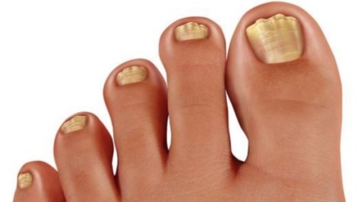 Τα λάθη που κάνετε και βγάζετε μύκητες στα νύχια – Τι να προσέχετε