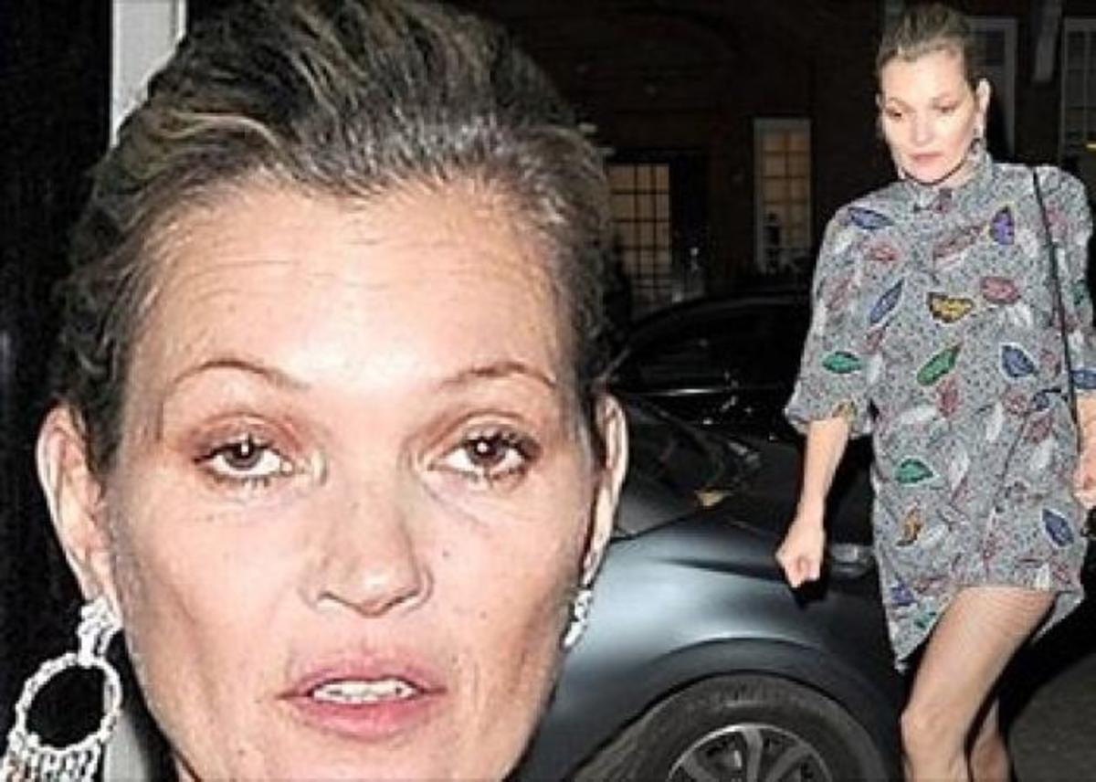 Η τραγική εμφάνιση της Kate Moss! Τι συνέβη;