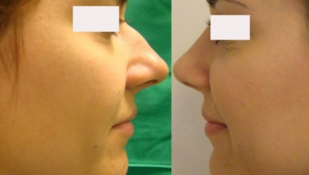 Τι μπορείτε να κάνετε για τα αντιαισθητικά λακουβάκια στο πλάι της μύτης