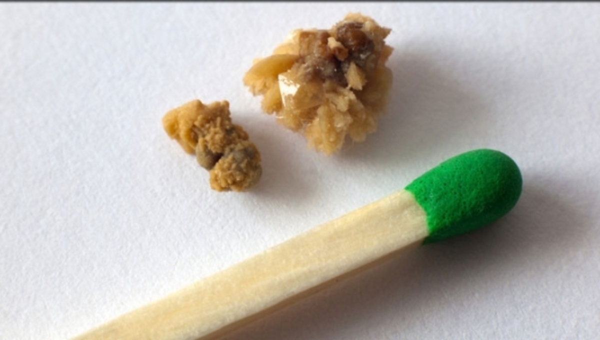 Αυτή είναι η μέθοδος που εγγυάται αποτελέσματα για τις πέτρες στα νεφρά