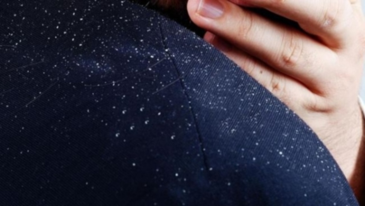 Πώς θα καταλάβετε αν οι άσπρες νιφάδες στα μαλλιά είναι από πιτυρίδα ή ξηροδερμία