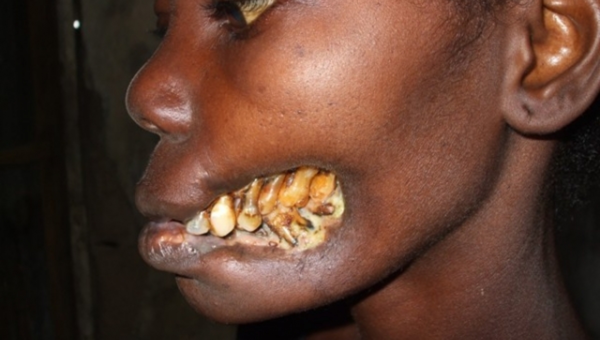 H ασθένεια NOMA, χτυπά τα παιδιά της Αφρικής – ΠΡΟΣΟΧΗ! Φωτογραφίες που σοκάρουν