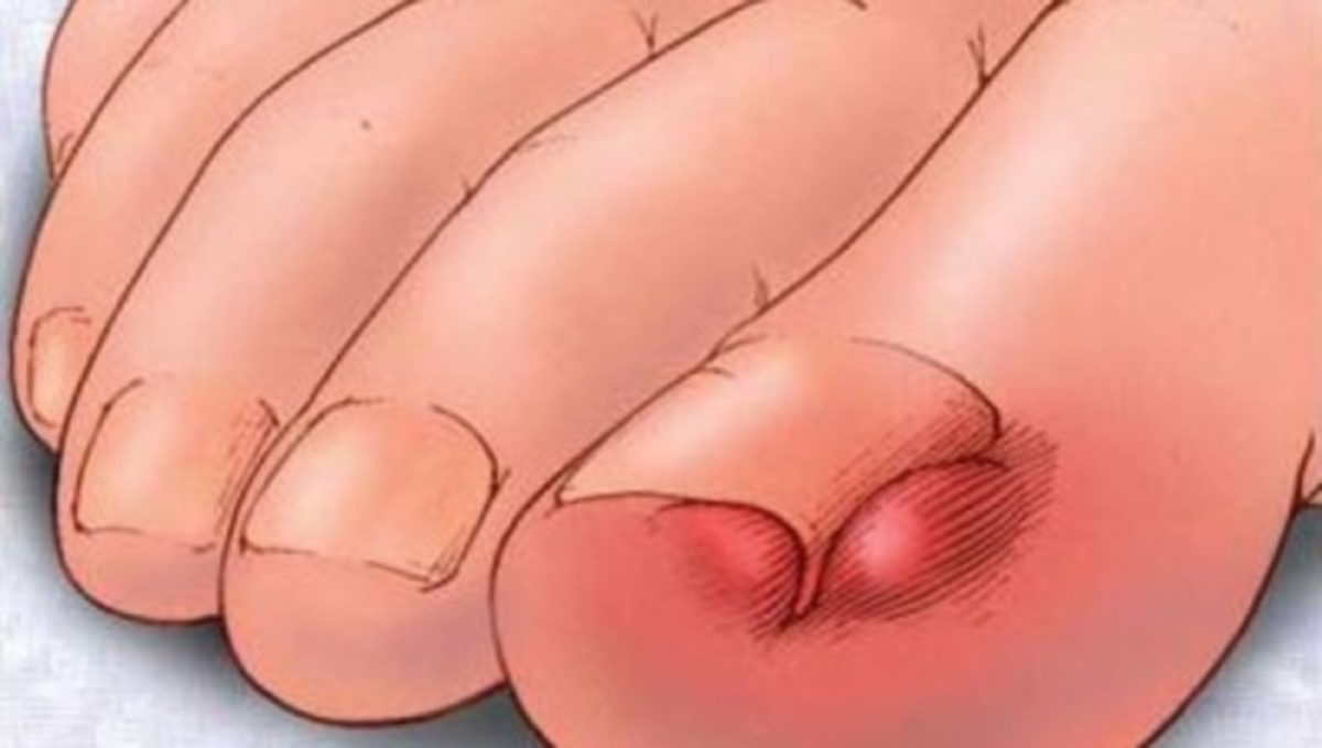 Έτσι θα απαλλαγείτε από το νύχι που μπαίνει μέσα στο δέρμα