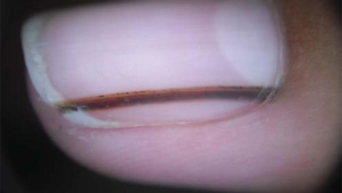 Προσοχή: Τι σημαίνει αν δείτε αυτό το σημάδι στο νύχι σας (Εικόνες – Βίντεο)