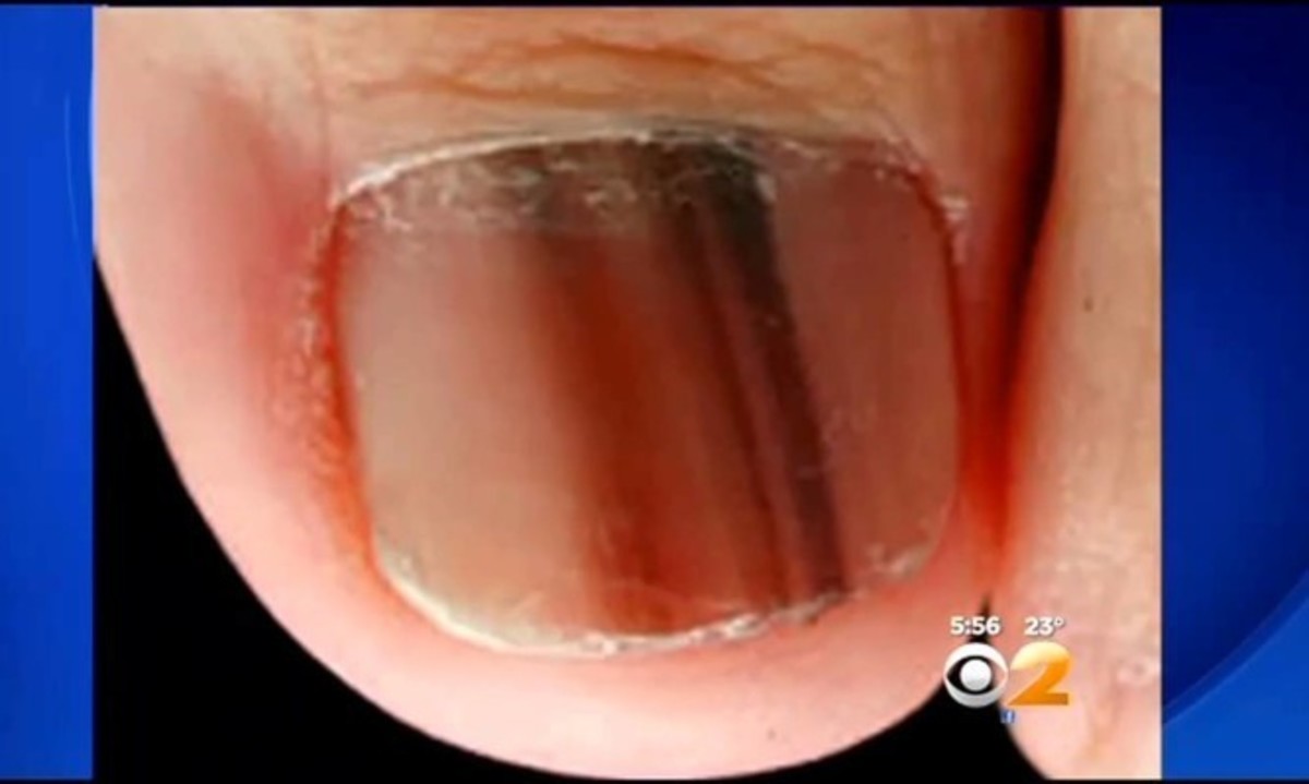 Προσοχή: Τι σημαίνει αν δείτε αυτό το σημάδι στο νύχι σας (Εικόνες – ΒΙΝΤΕΟ)