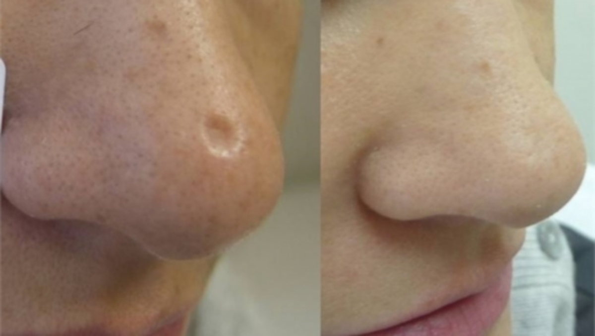 Πώς θα απαλλαγείτε από τις μικρές ουλές στο δέρμα – Τα 4 βασικά φυσικά υλικά