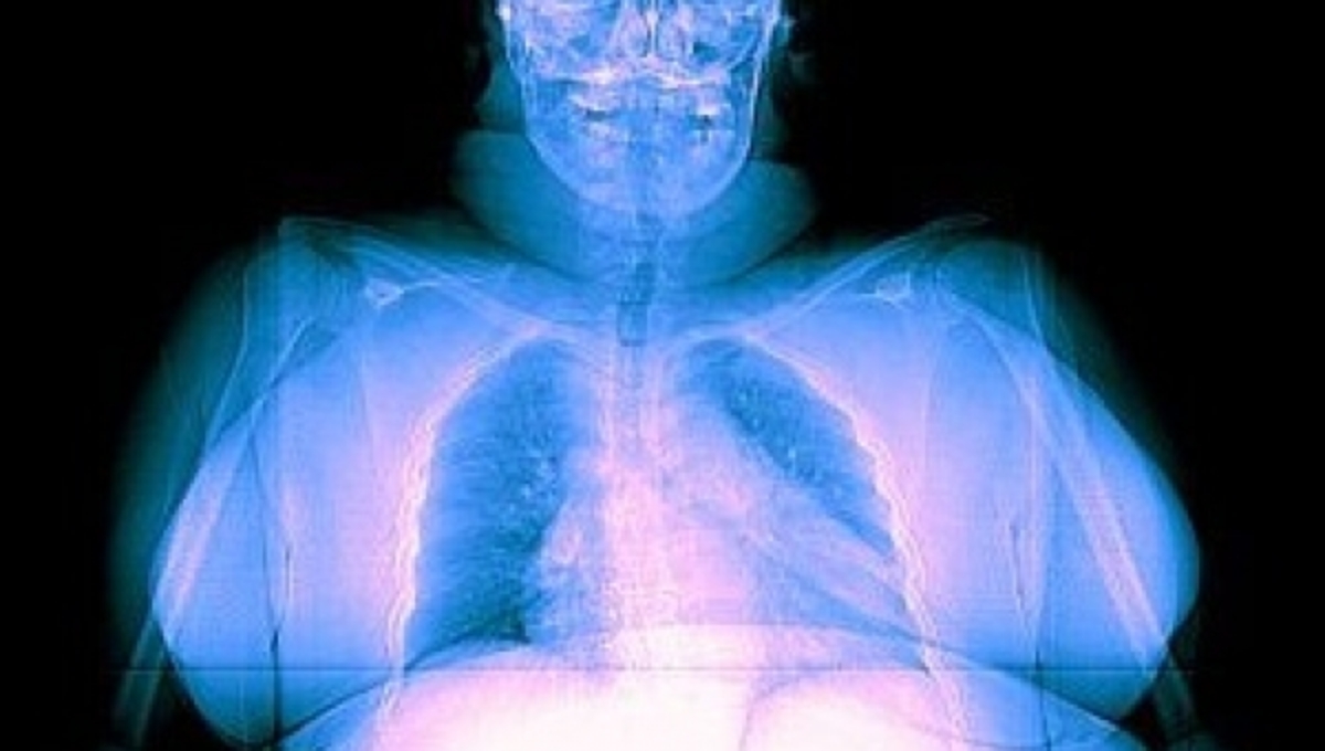 Οι παχύσαρκοι δέχονται περισσότερη ακτινοβολία στις ακτινογραφίες