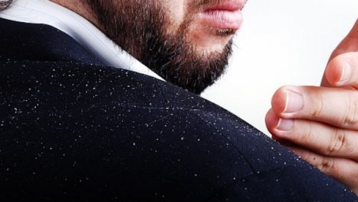 Τι συμβαίνει τελικά με την πιτυρίδα που επιμένει…