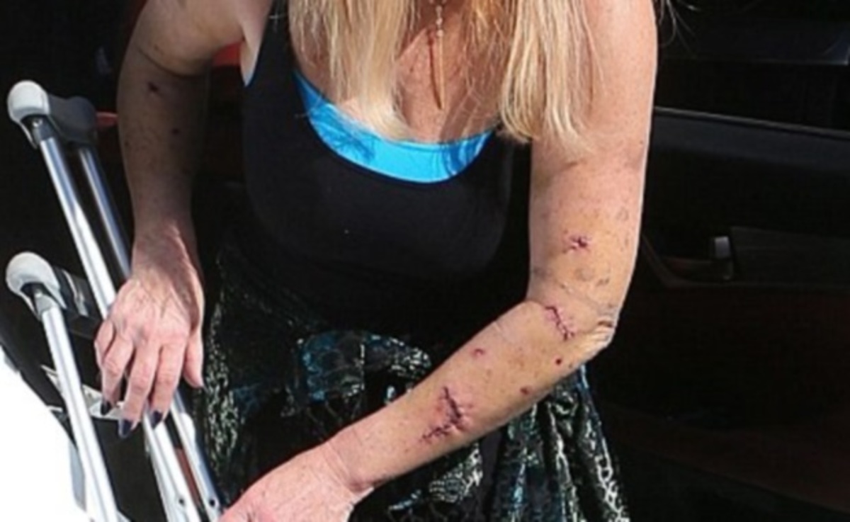 Επιτέθηκαν σκυλιά σε ηθοποιό – Ανατριχιαστικές φωτογραφίες!