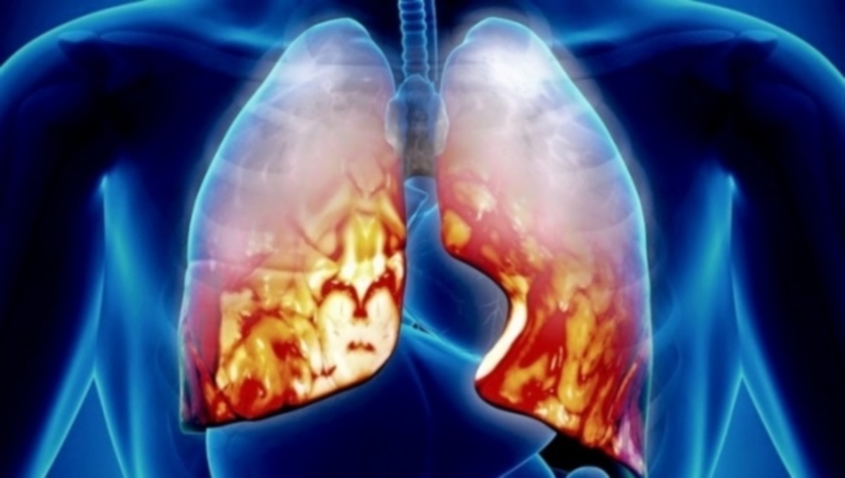 Πώς θα καταλάβετε αν είστε στα πρόθυρα πνευμονίας – ΄Τα βασικά αίτια και συμπτώματα