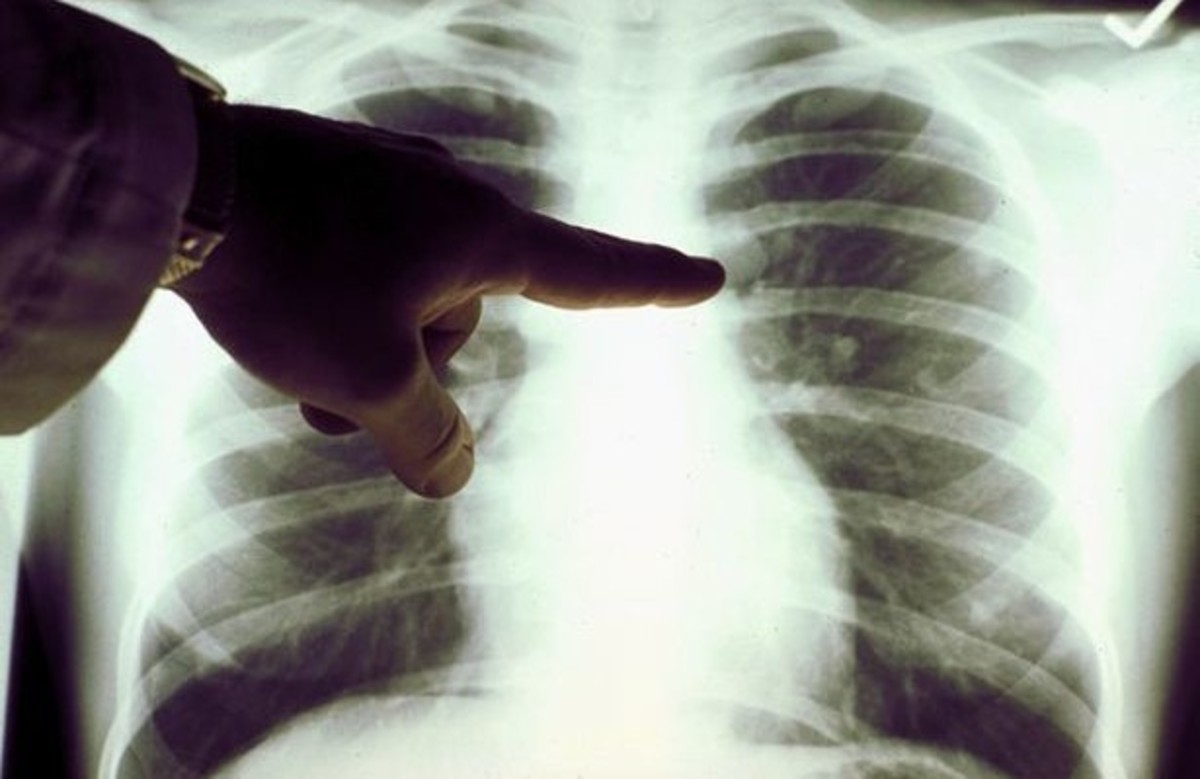 SOS: Τα σημάδια που δείχνουν συσσώρευση υγρού στον πνεύμονα