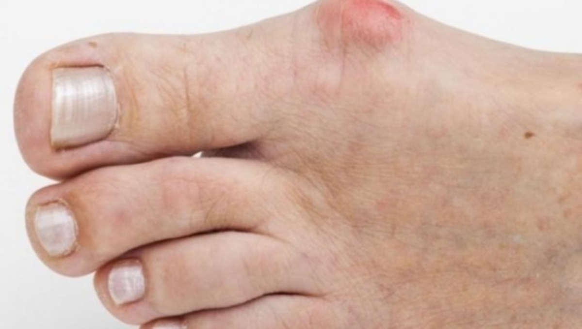 Γιατί σας δημιουργείται ‘κότσι’ στο μεγάλο δάχτυλο – Πώς αντιμετωπίζεται (ΒΙΝΤΕΟ)