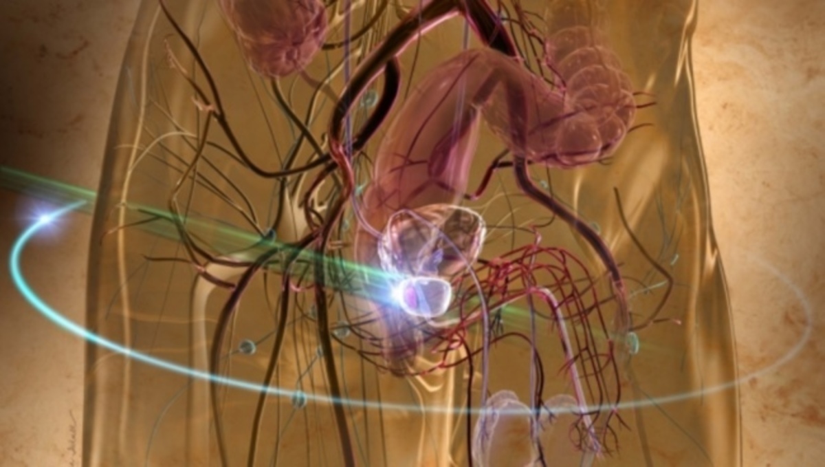 Καρκίνος του προστάτη: Αυτά είναι τα πρώιμα, ‘αθώα’ συμπτώματα – Πώς εντοπίζεται εγκαίρως