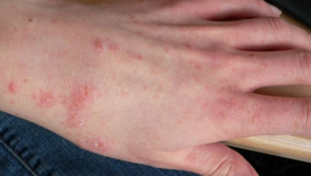Έτσι φαίνεται η ψώρα στο δέρμα – Πώς εκδηλώνεται και ποια θεραπεία υπάρχει