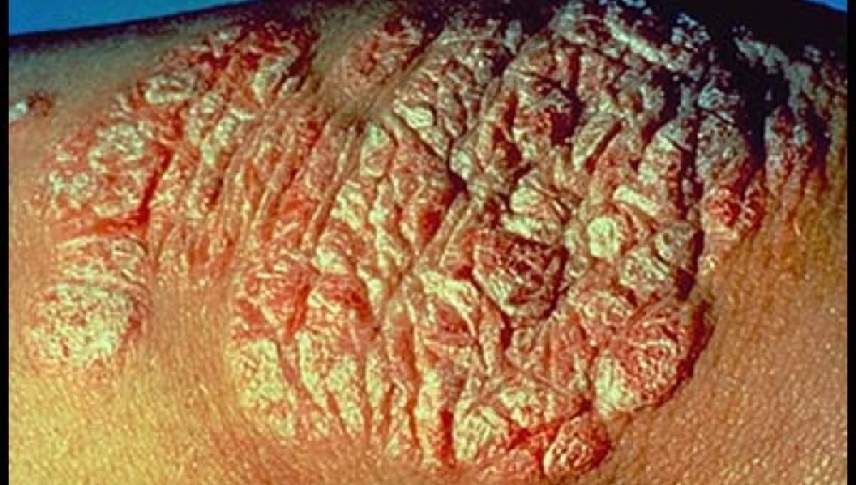 Έρευνα Iatropedia: Η άγνωστη ψωρίαση – Τα αίτια και η προδιάθεση