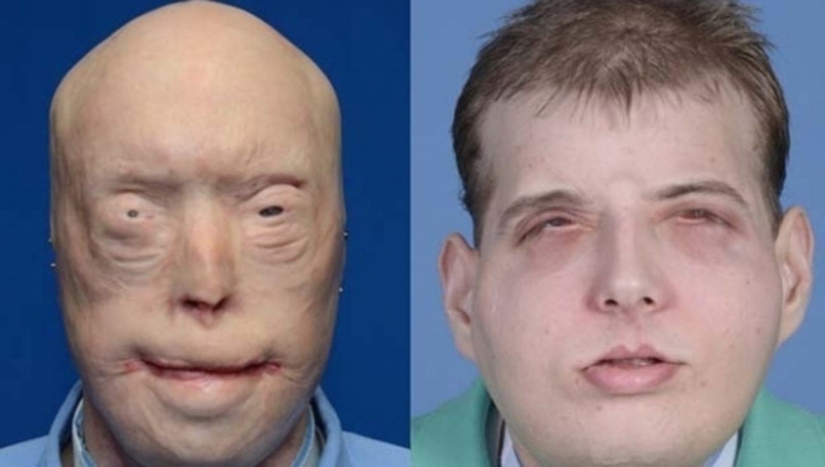 ΣΥΓΚΛΟΝΙΣΤΙΚΟ: Η ιστορία του πυροσβέστη που έκανε επέμβαση μεταμόσχευσης προσώπου (ΒΙΝΤΕΟ)