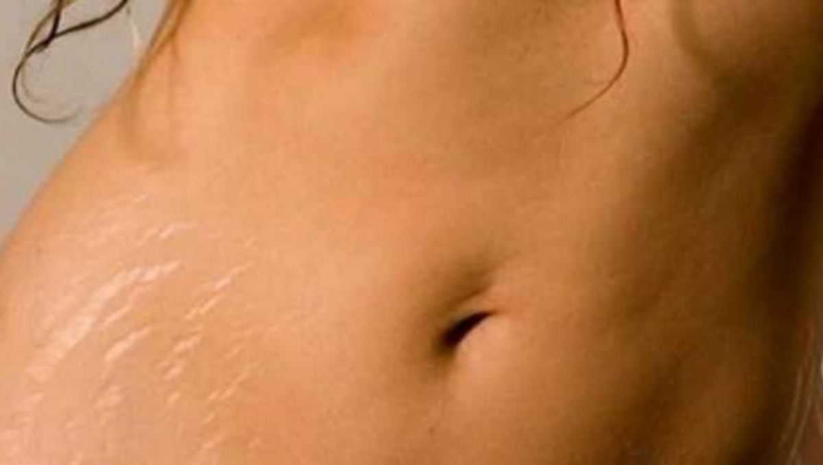 Έτσι θα απομακρύνετε οριστικά της αντιαισθητικές ραγάδες