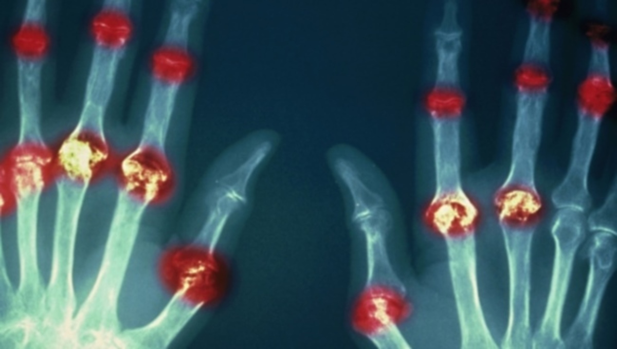 Αν νιώθετε αυτά είστε στα πρόθυρα ρευματοειδούς αρθρίτιδας – Ποια είναι η θεραπεία