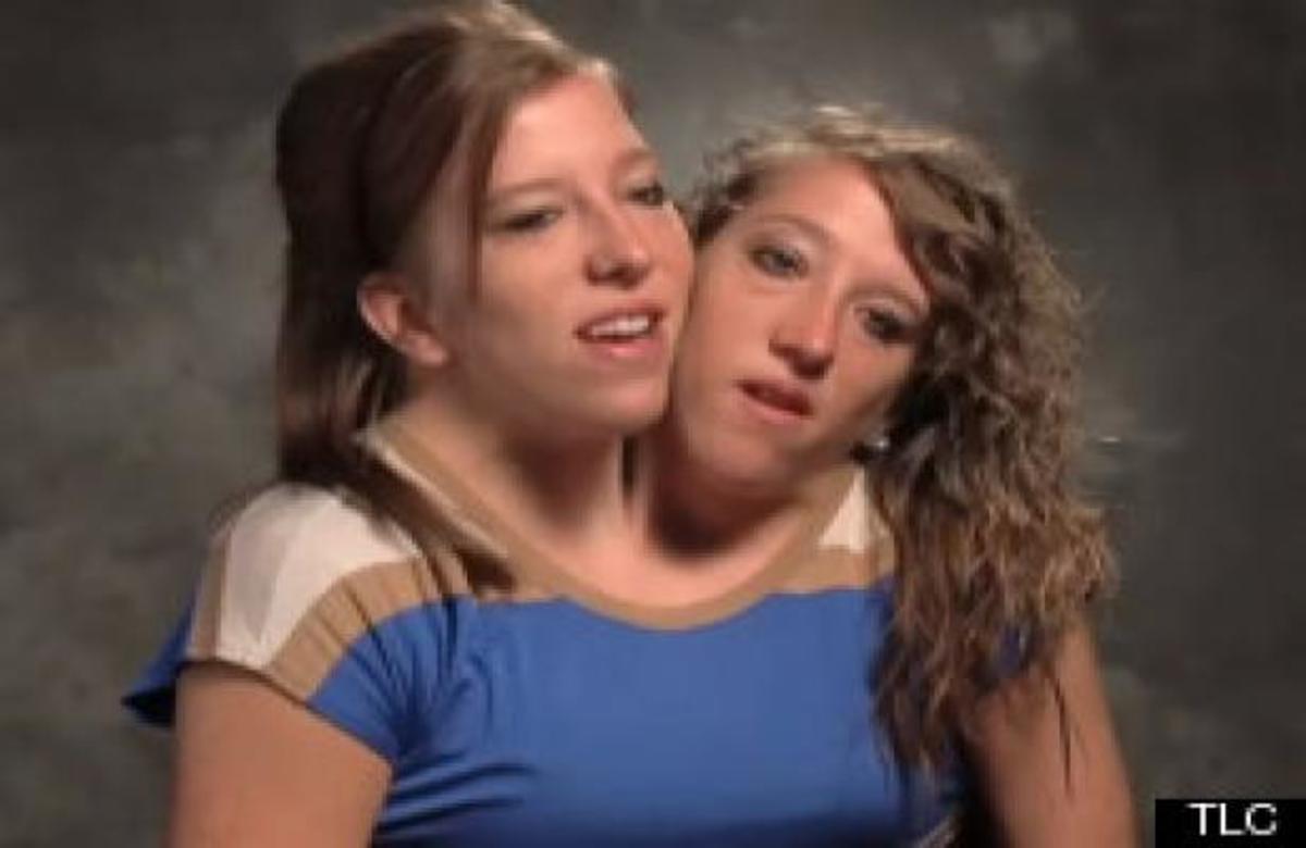 Συγκλονίζει η ιστορία των σιαμαίων κοριτσιών που θα κάνουν τη ζωή τους ριάλιτι!