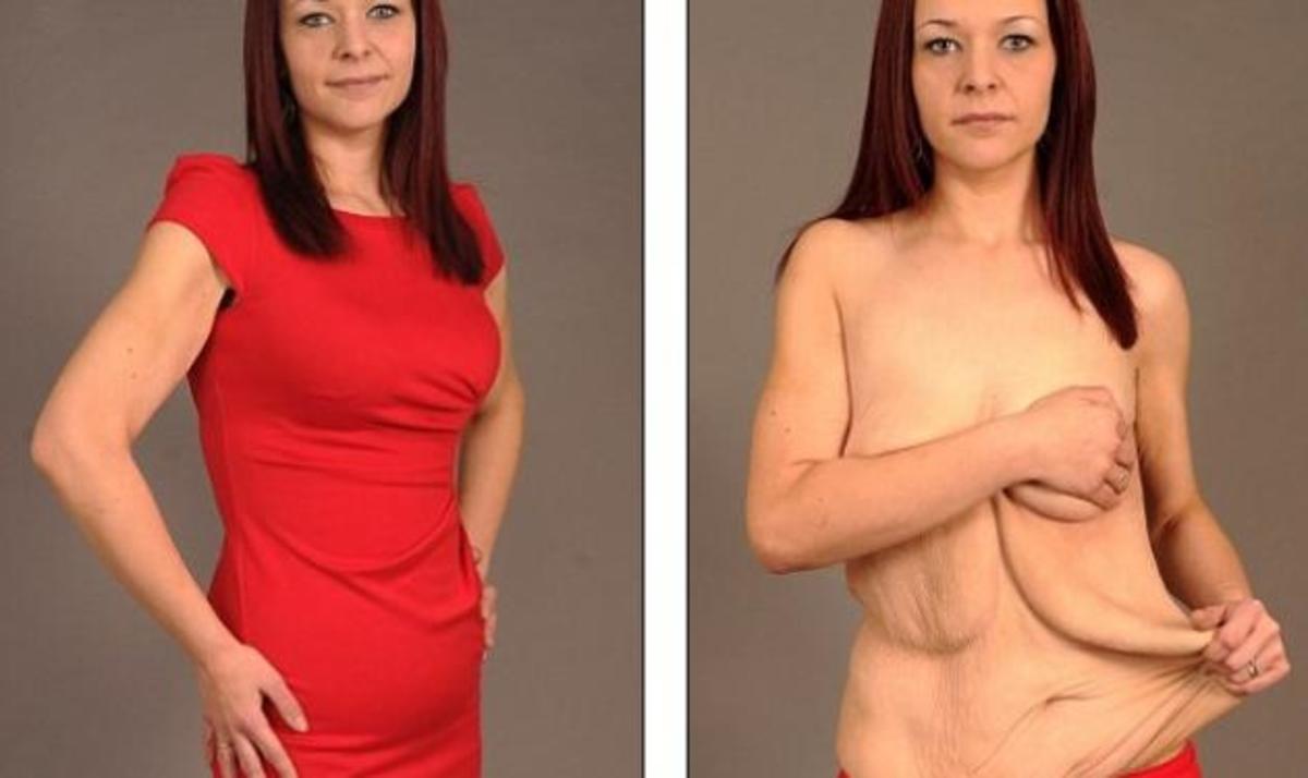 Σοκάρουν οι φωτογραφίες της 23χρονης που έχασε 57 κιλά! Καταστράφηκε η σεξουαλική μου ζωή!