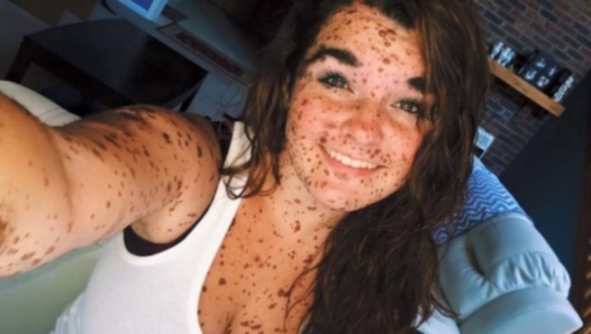 Μαθήματα ζωής’ από κοπέλα με σημάδια στο 70% του σώματός της – Τι της συμβαίνει (εικόνες)