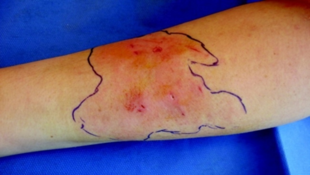 Προσοχή: Τα σημάδια που δείχνουν ότι έχετε μολυνθεί από σταφυλόκοκκο