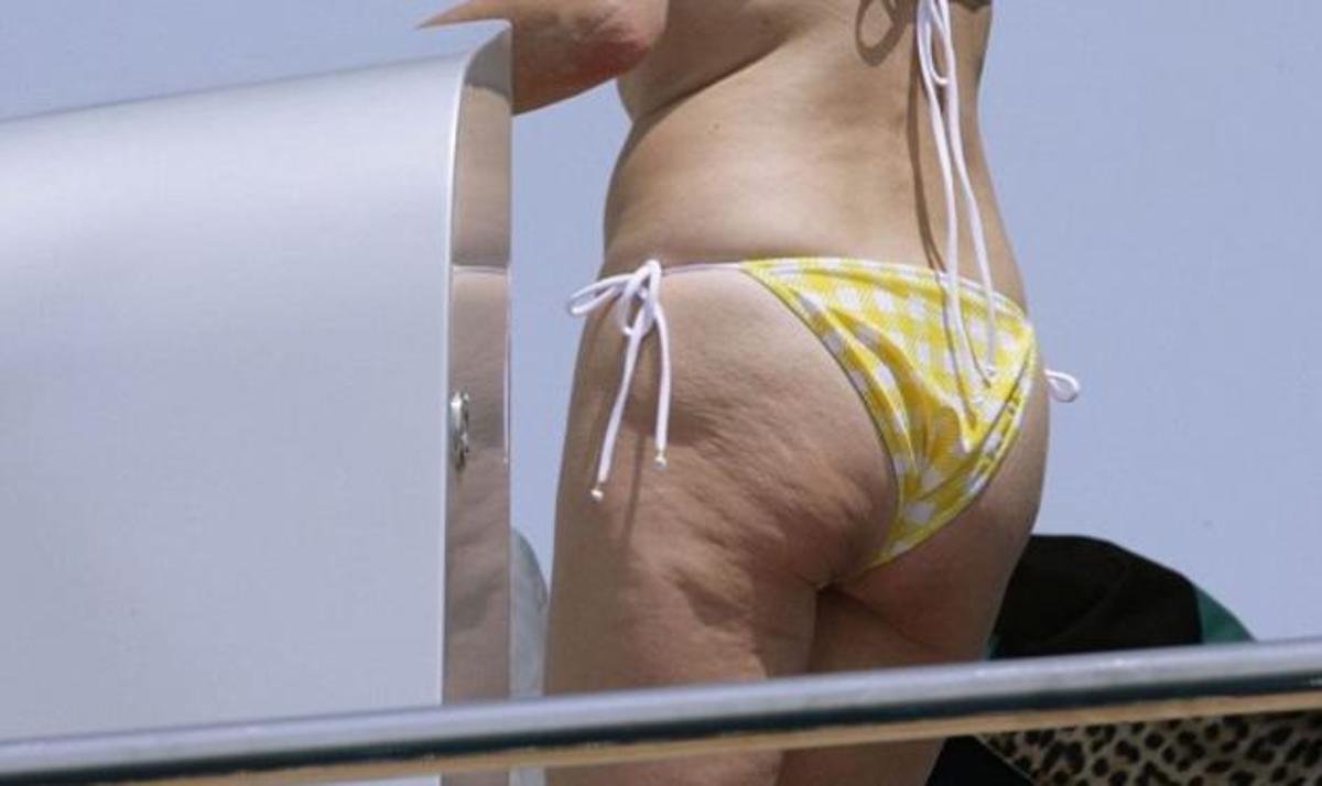 Έχει κυτταρίτιδα και δεν το κρύβει! Για ποια επώνυμη πρόκειται;