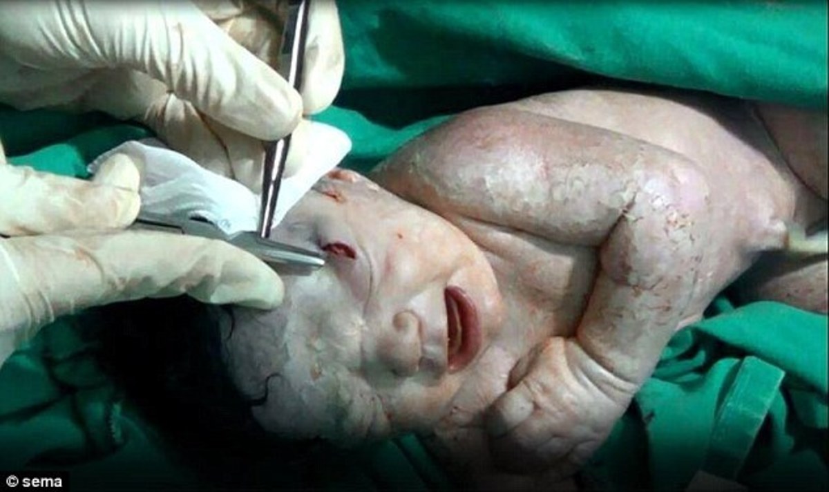 Βρέφος στη Συρία γεννήθηκε με θραύσμα οβίδας στο κεφάλι! (ΦΩΤΟ, VIDEO)