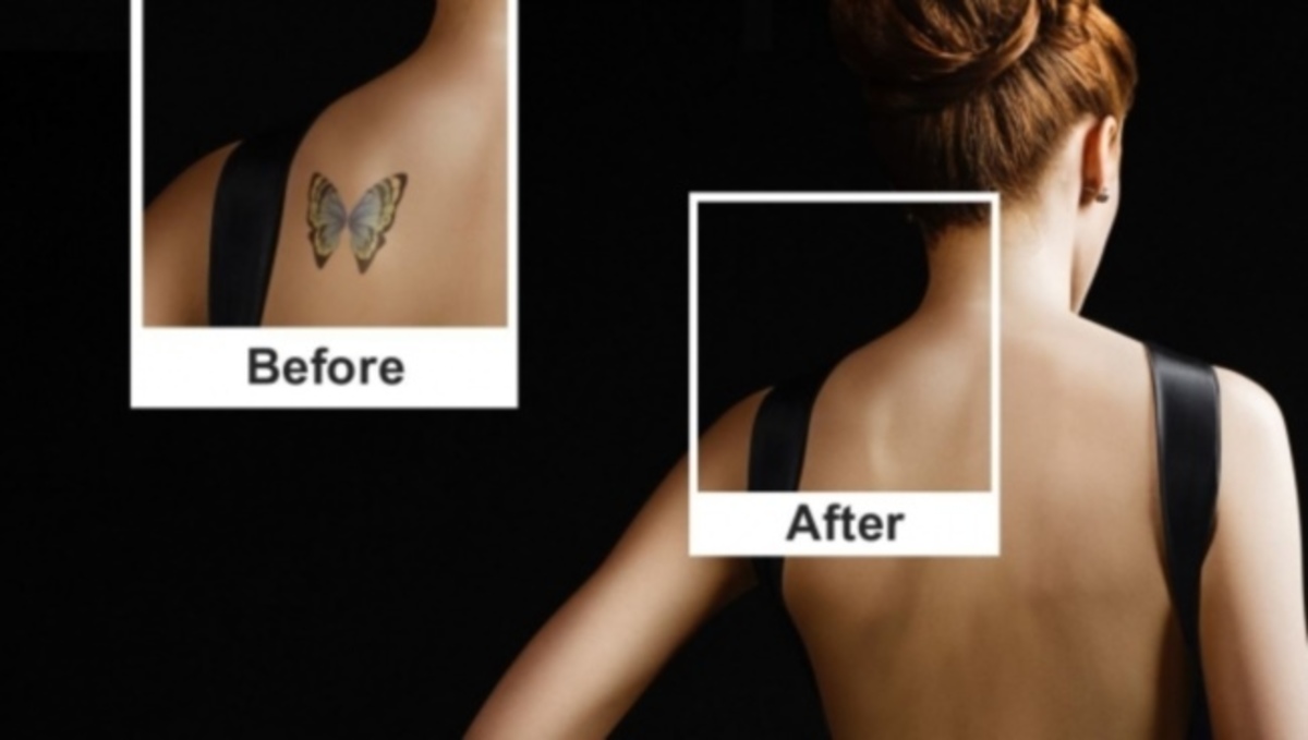 Πώς να αφαιρέσετε ένα τατουάζ με ασφάλεια για την υγεία σας