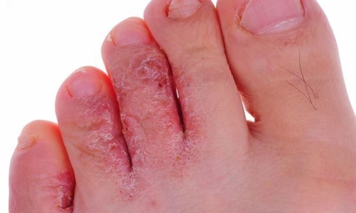 Μυκητίαση στα δάχτυλα και τα νύχια: Τι μπορείτε να κάνετε