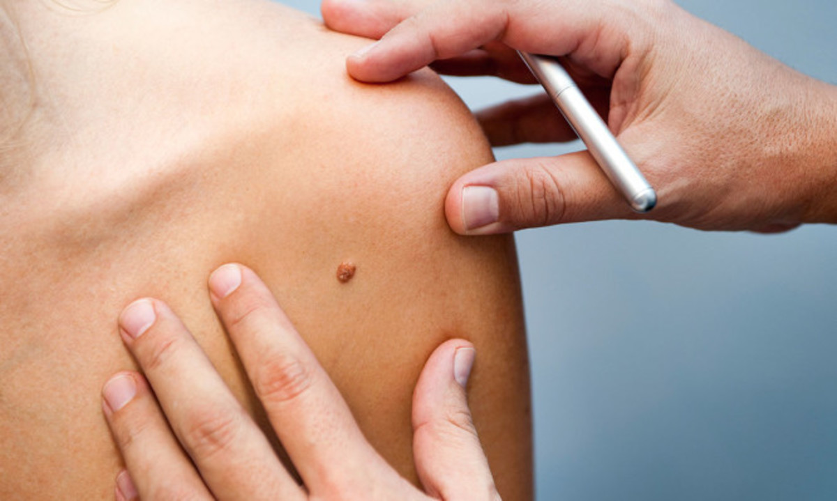 Έρευνα: Πότε οι ελιές στο δέρμα γίνονται καρκινικά μελανώματα