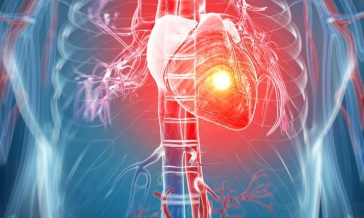 Προσοχή στο «σιωπηλό» έμφραγμα: Πώς εκδηλώνεται – Τι να προσέχετε