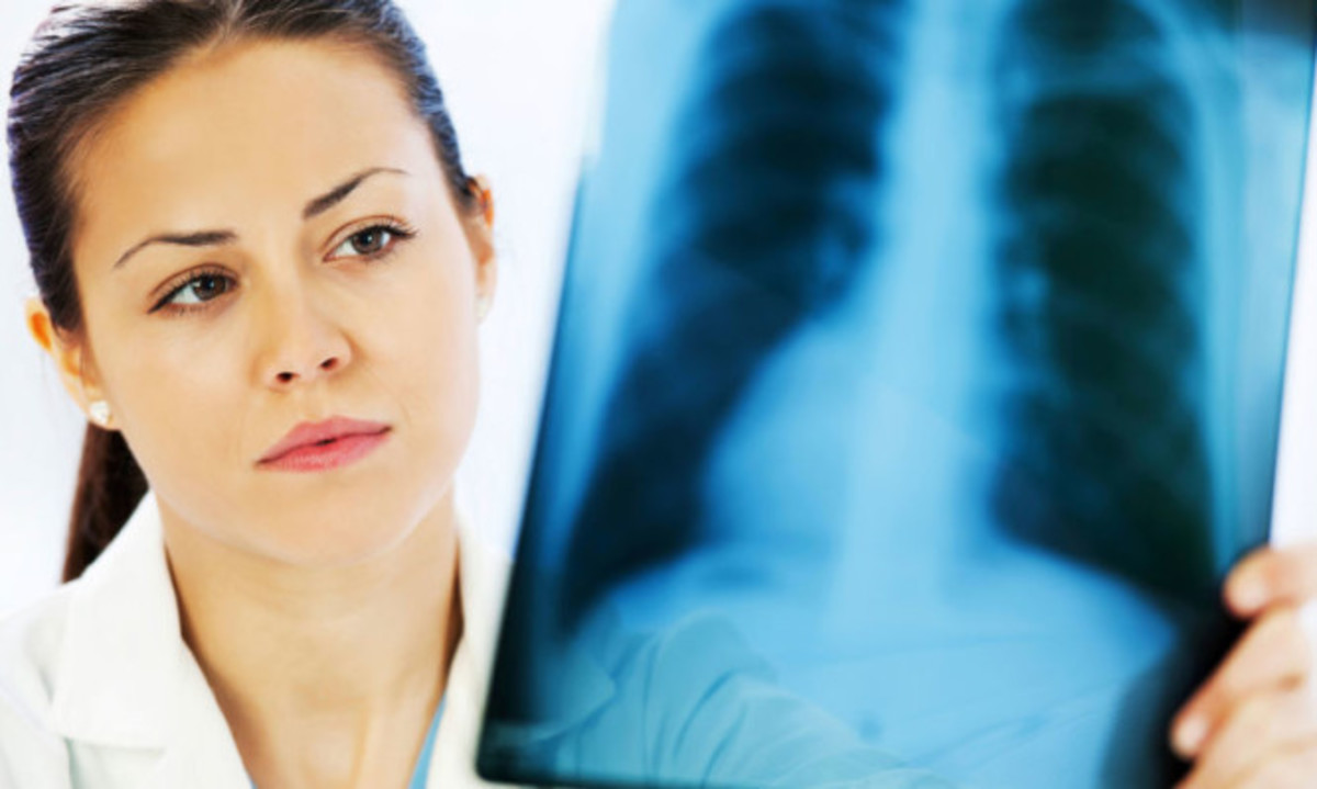 Παγκόσμια Ημέρα Φυματίωσης: Μήνυμα εγρήγορσης από τον ΠΟΥ – Τα συμπτώματα της ασθένειας