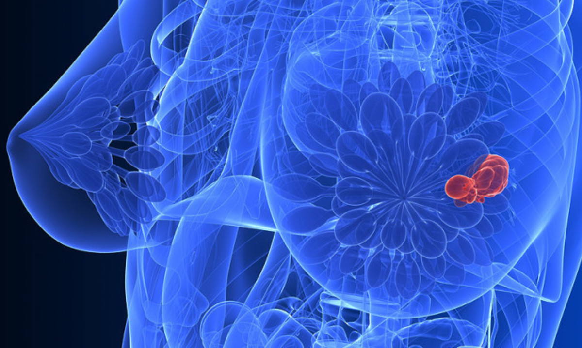 Καρκίνος του μαστού: Μεγάλη ανακάλυψη από Έλληνα επιστήμονα