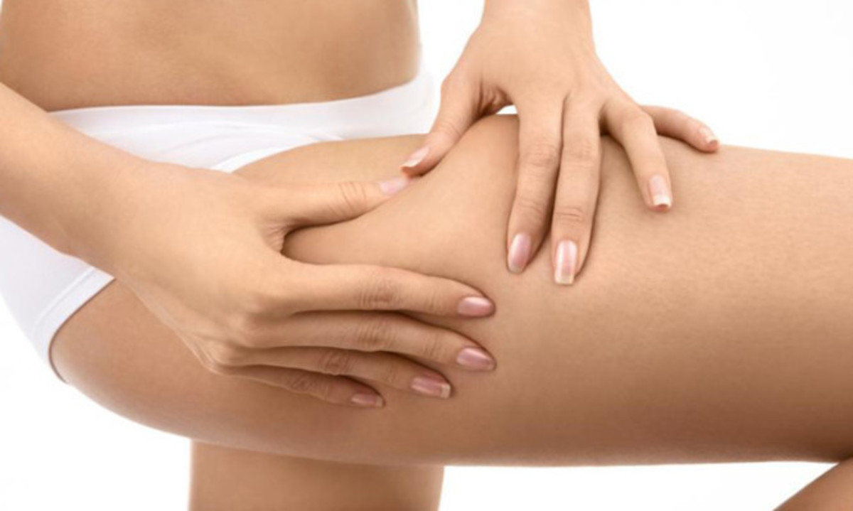 Κρυολιπόλυση: Τα πάντα για την αφαίρεση τοπικού λίπους χωρίς νυστέρι