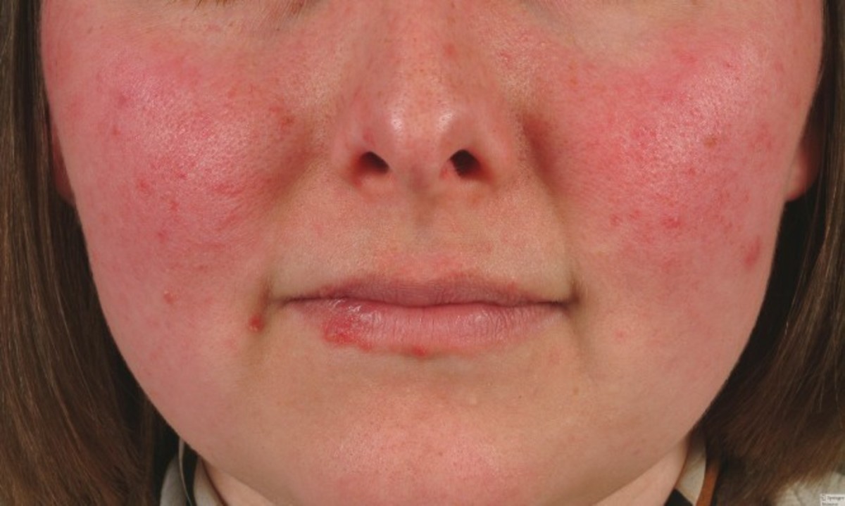 Συστηματικός ερυθηματώδης λύκος: Τι σπουδαίο ανακάλυψαν Έλληνες ερευνητές