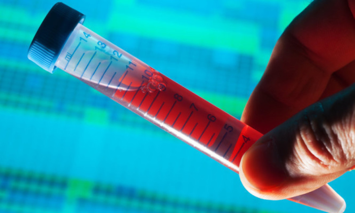 Πάρκινσον: Έγκαιρη ανίχνευση με απλό τεστ αίματος – Πώς θα γίνεται το τεστ