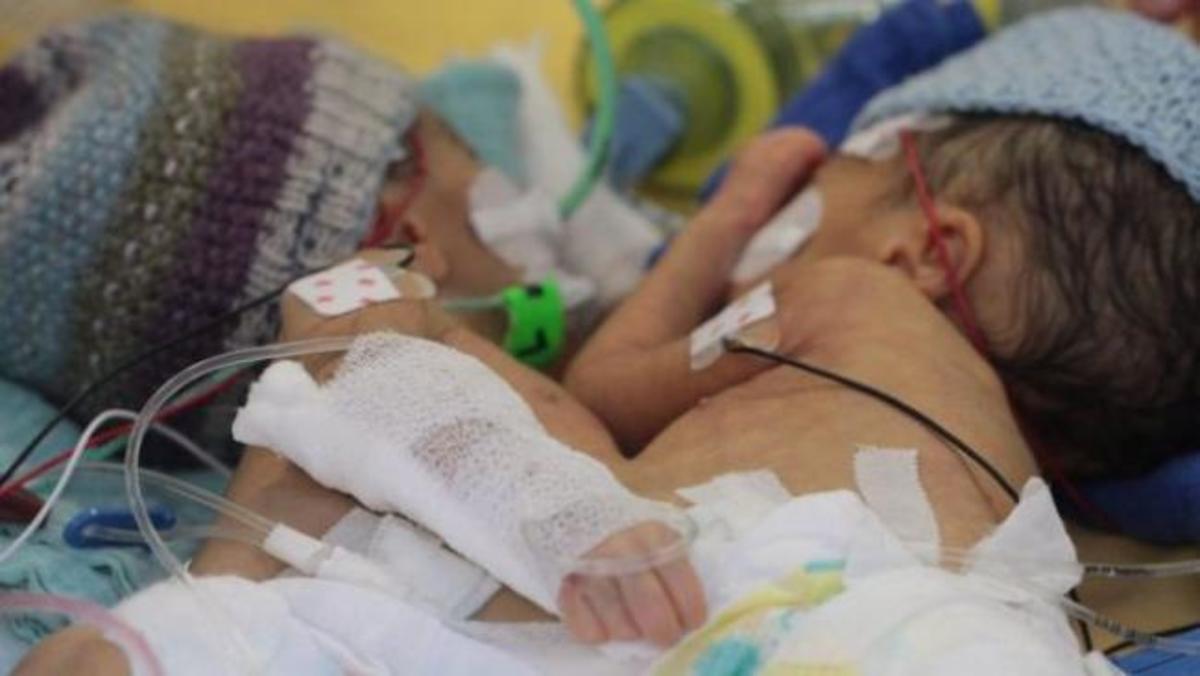 Γεγονός ο διαχωρισμός των νεαρότερων σιαμαίων στην ιστορία! (φωτογραφίες)