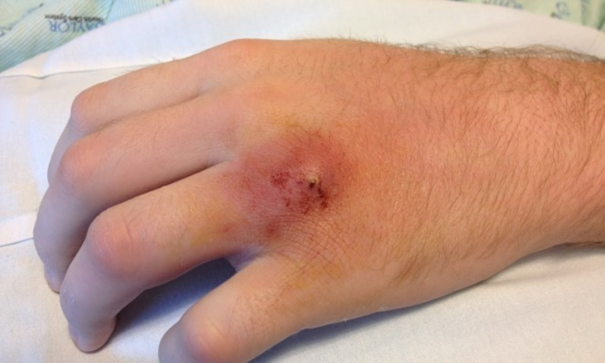 Έτσι εκδηλώνεται ο σταφυλόκοκκος στο δέρμα – Πώς θα τον αναγνωρίσετε