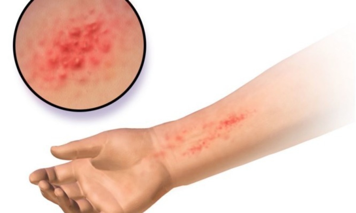 Δερματίτιδα εξ επαφής: Πότε συμβαίνει – Τι την «πυροδοτεί»