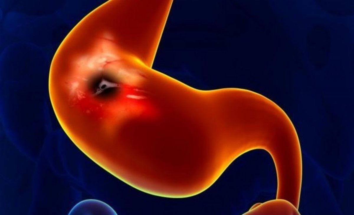 Τι πρέπει να ξέρετε για το έλκος στομάχου – Προσοχή στα πρώιμα σημάδια