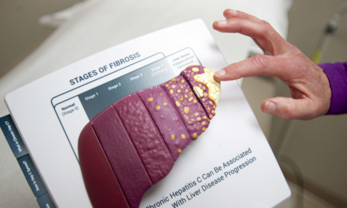 Ηπατίτιδα C: Ελπίδες για θεραπεία σε λίγες εβδομάδες με συνδυασμό φαρμάκων