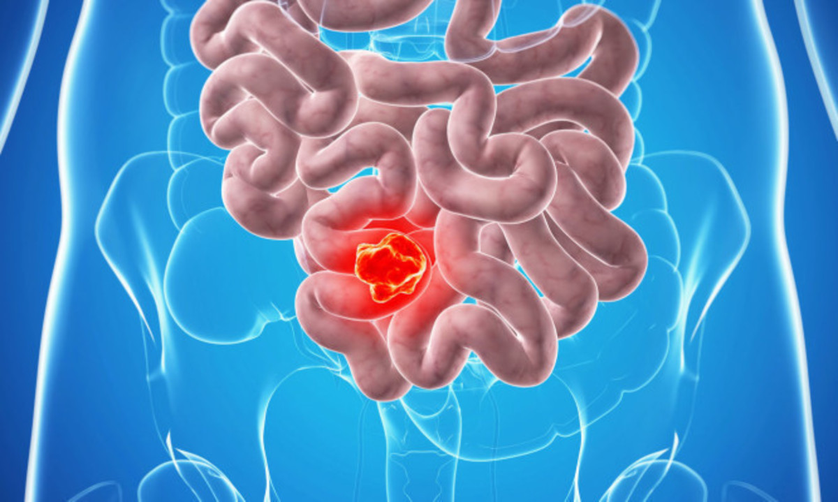 Καρκίνος του εντέρου: Συμπτώματα και πώς σχετίζεται με την… ανάπτυξη της χώρας