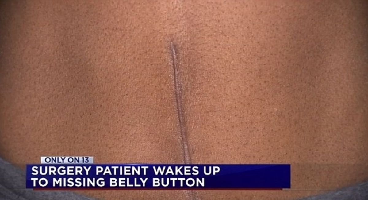 Απίστευτο: Μπήκε για κοιλιοπλαστική επέμβαση, ξύπνησε χωρίς… αφαλό! (ΒΙΝΤΕΟ)