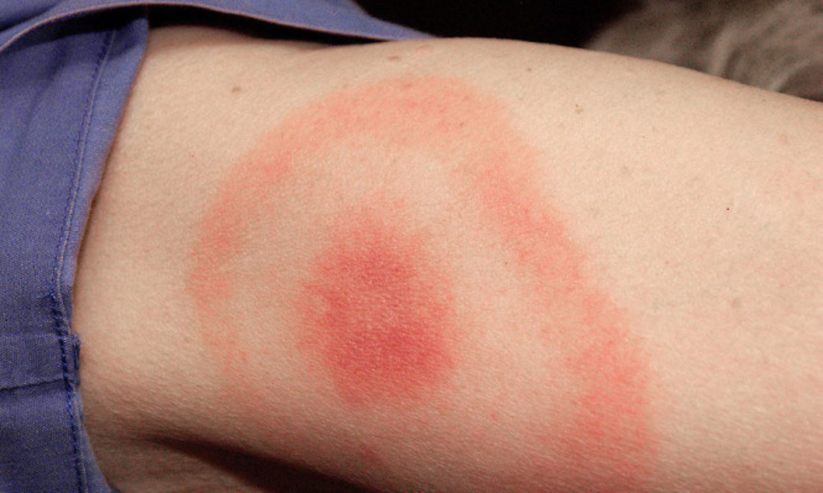 Αν δείτε αυτό το σημάδι στο σώμα σας, πηγαίνετε στο γιατρό – Επικίνδυνο τσίμπημα!