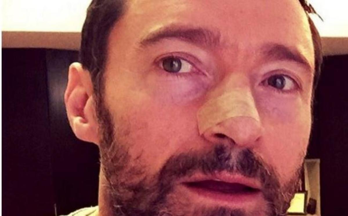 Βασικοκυτταρικό καρκίνωμα: Τι έπαθε ο Χιου Τζάκμαν – Όλοι οι δερματικοί κίνδυνοι από τον ήλιο