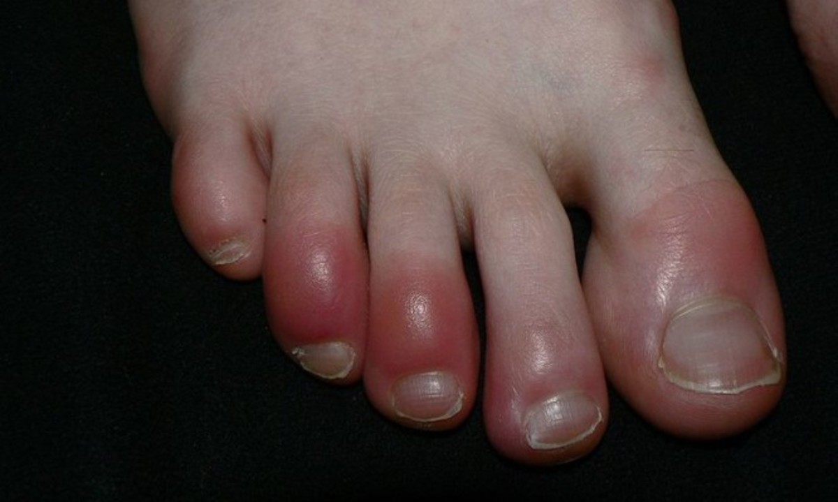 Χιονίστρες: Αίτια, συμπτώματα και θεραπεία